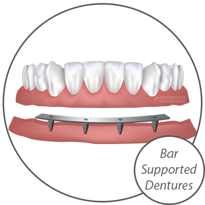 Dr. Peters Offers a Variety of Dental Implant Options