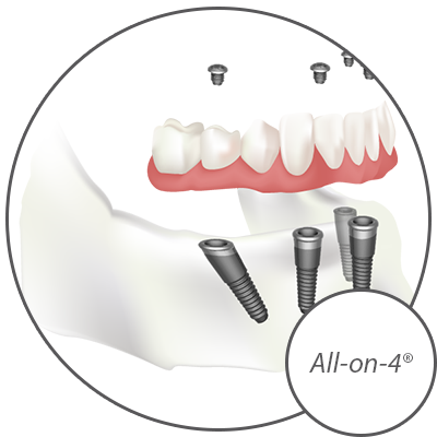 Dr. Peters Offers a Variety of Dental Implant Options